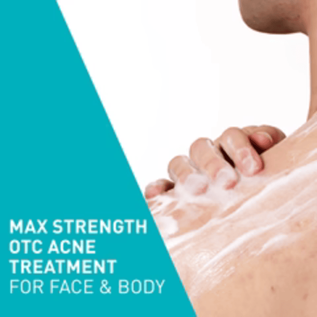 CeraVe  Acne Foaming Cream Cleanser | Acne Treatment Face Wash with 4% Benzoyl Peroxide, Hyaluronic Acid, and Niacinamide | Cream to Foam Formula | 5 Oz