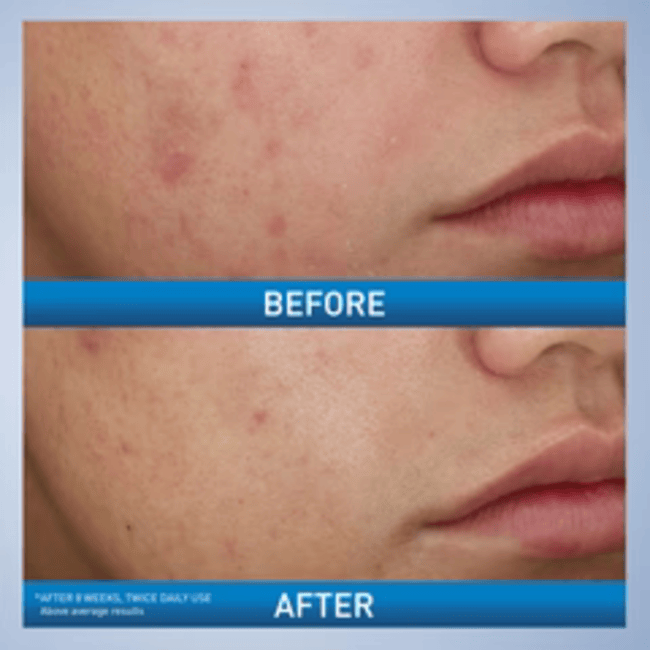 CeraVe  Acne Foaming Cream Cleanser | Acne Treatment Face Wash with 4% Benzoyl Peroxide, Hyaluronic Acid, and Niacinamide | Cream to Foam Formula | 5 Oz