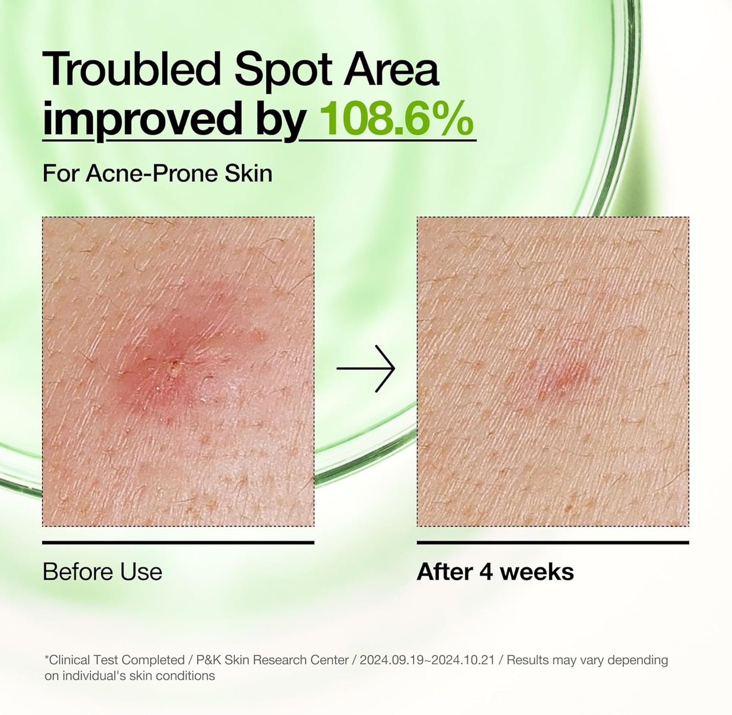 ANUA Azelaic Acid 10% Hyaluron Serum 30ml – Redness Soothing, Acne Treatment & Brightening Serum in Pakistan