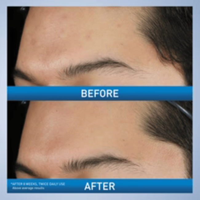 CeraVe  Acne Foaming Cream Cleanser | Acne Treatment Face Wash with 4% Benzoyl Peroxide, Hyaluronic Acid, and Niacinamide | Cream to Foam Formula | 5 Oz